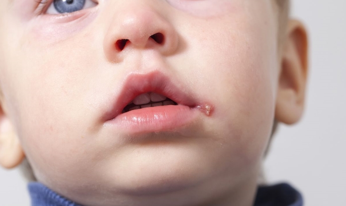 herpes labial na infancia